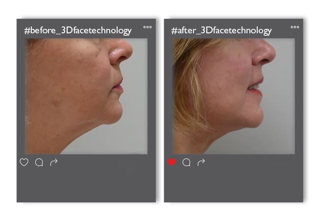3dfacetechnology_enthesi_1