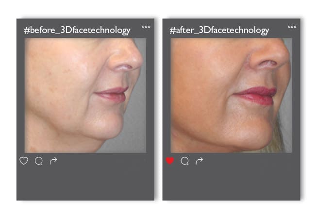 3dfacetechnology_enthesi_3