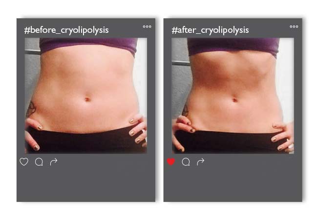 Cryolipolysis_v1