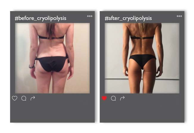 Cryolipolysis_v2