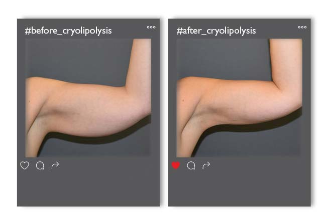 Cryolipolysis_v3