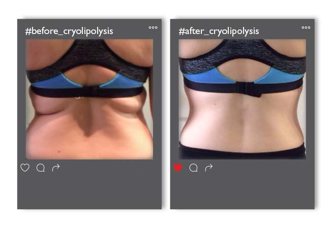 Cryolipolysis_v4