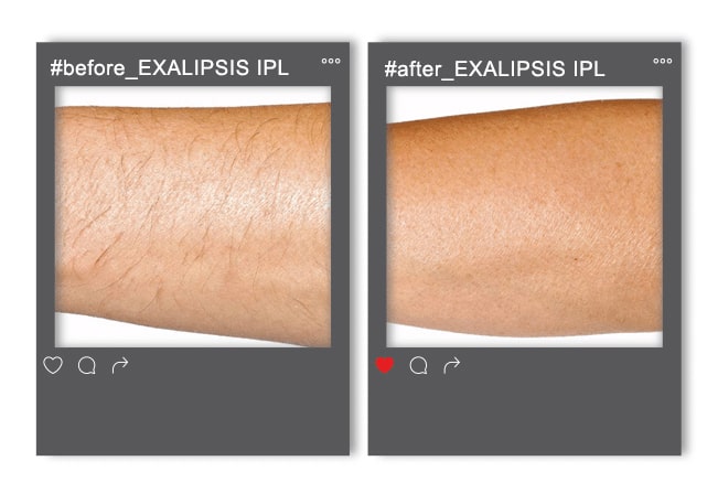 Photothermolysis_enthesi_3-min(1)