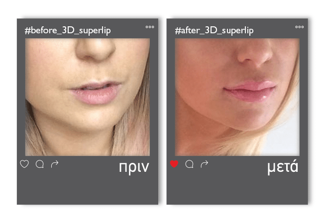 3Dsuperlip_v1