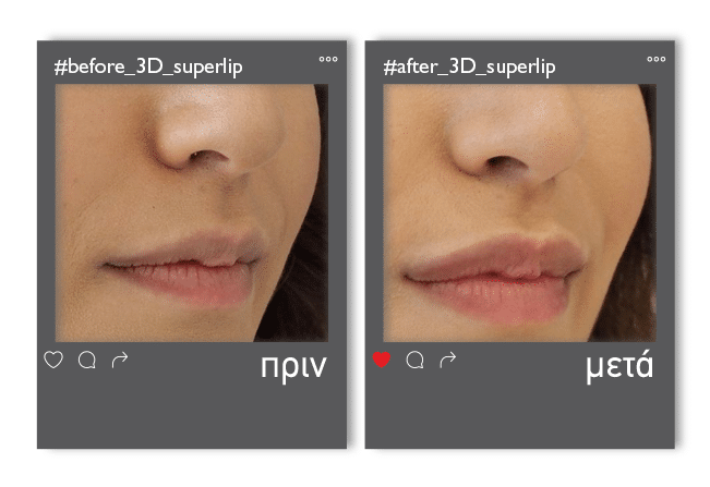 3Dsuperlip_v2
