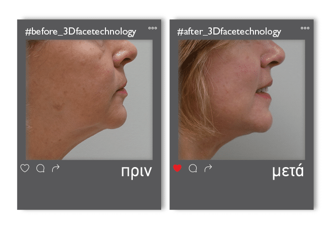 3dfacetechnology_enthesi_1