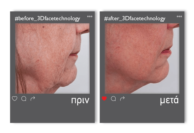 3dfacetechnology_enthesi_2