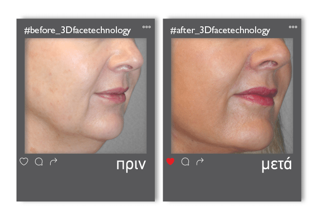 3dfacetechnology_enthesi_3