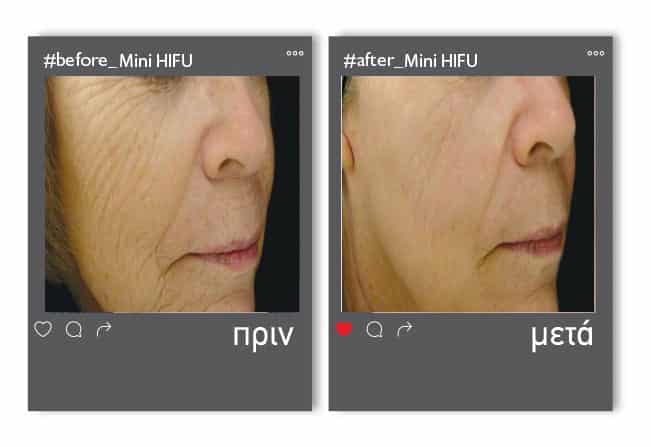 before_mini_hifu1-1