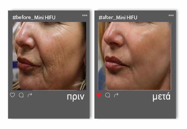 before_mini_hifu2