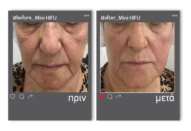 before_mini_hifu3