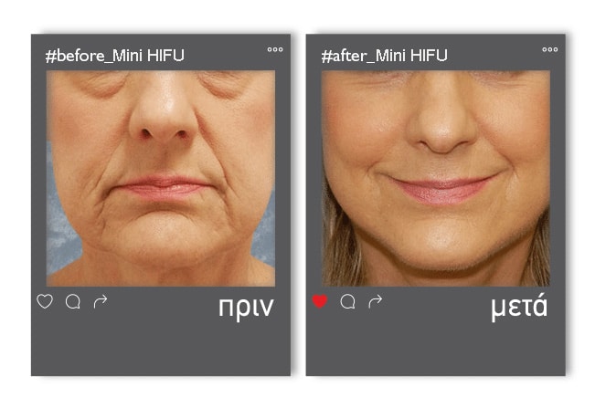 minI-hifu_before_after6