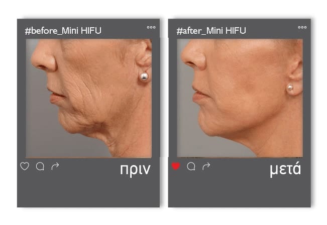 minI-hifu_before_after7