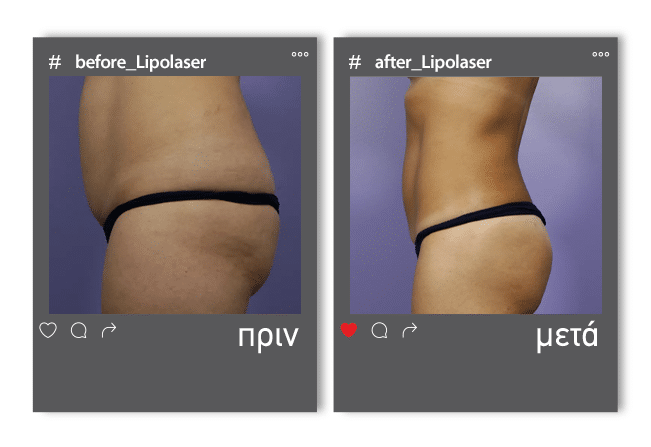 Lipolaser Before 1