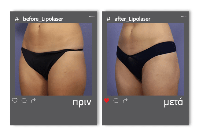 Lipolaser Before 2