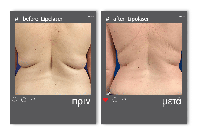 Lipolaser Before 3