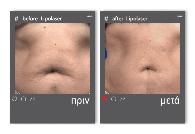 Lipolaser Before 4
