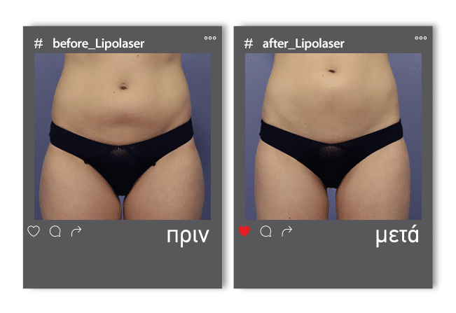 Lipolaser Before 5