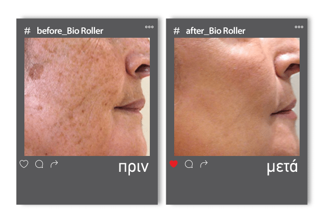 Before_After rolelr1