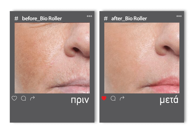 Before_After roller5