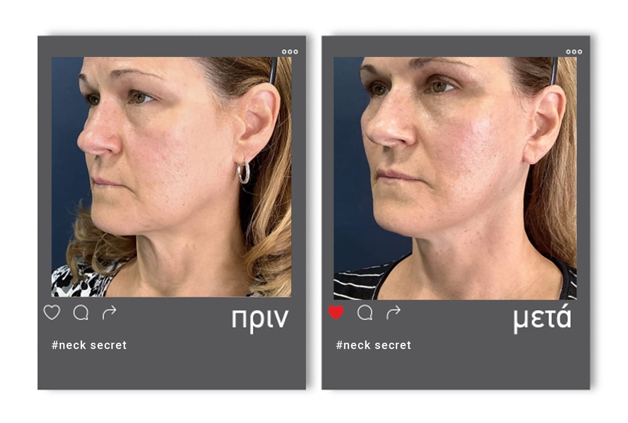 Before-after-neck-secret-1