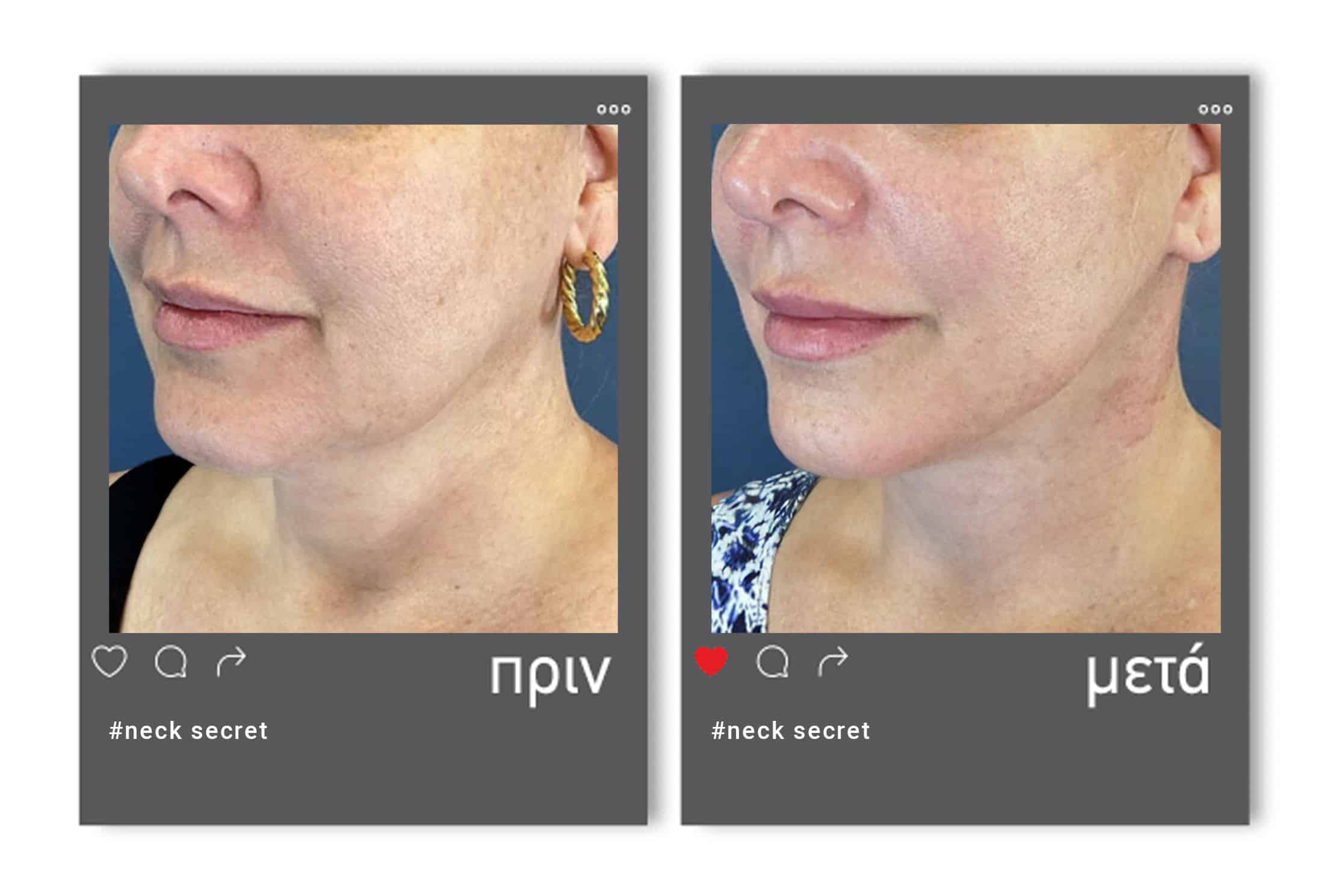 Before-after-neck-secret-3