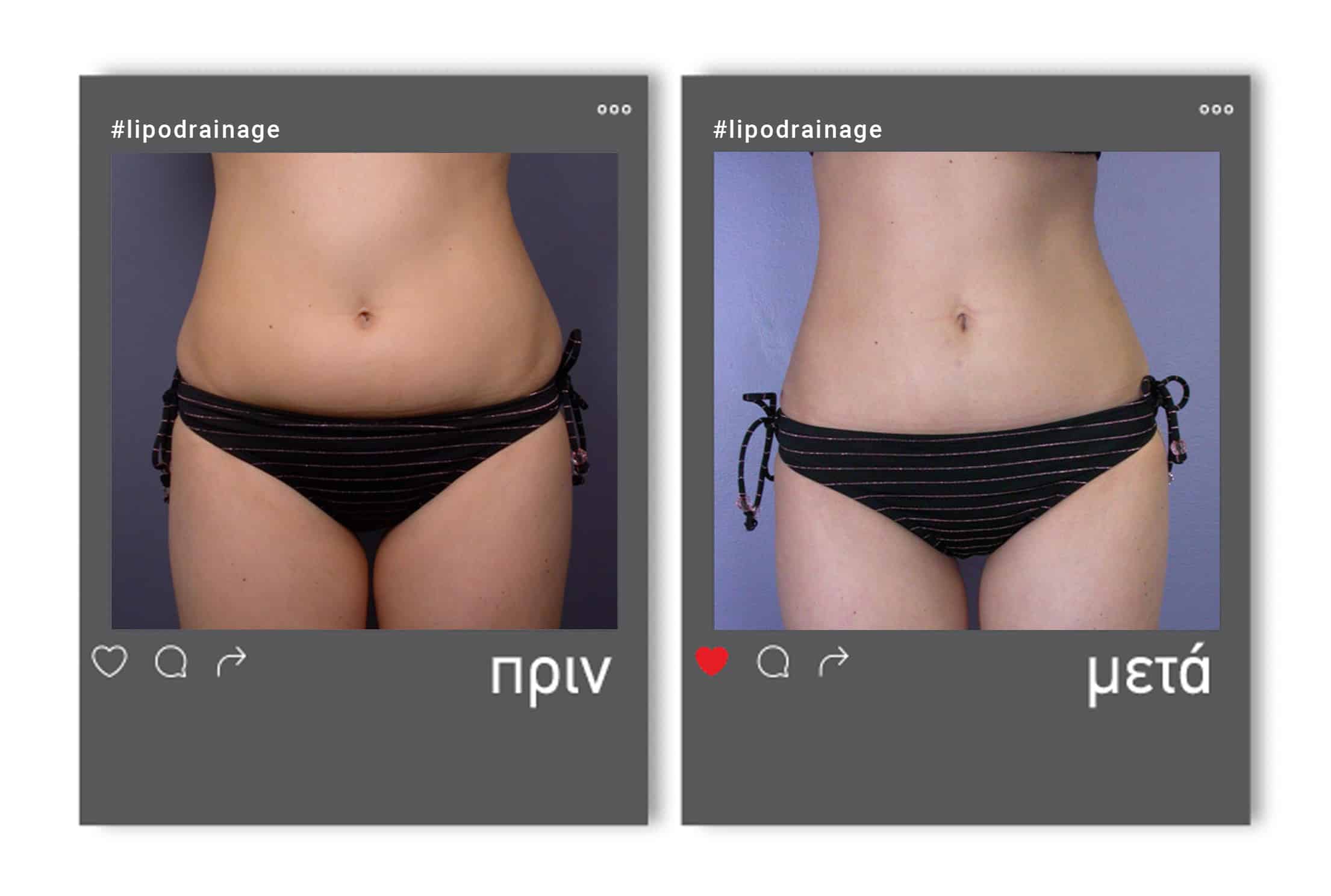 lipodrainage_befafter_1