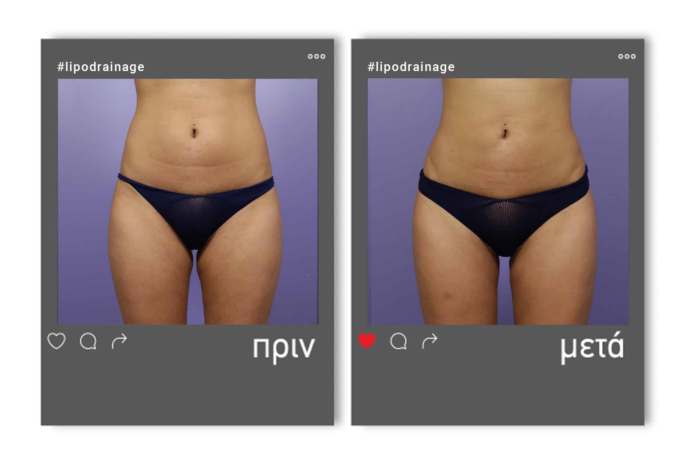 lipodrainage_befafter_2