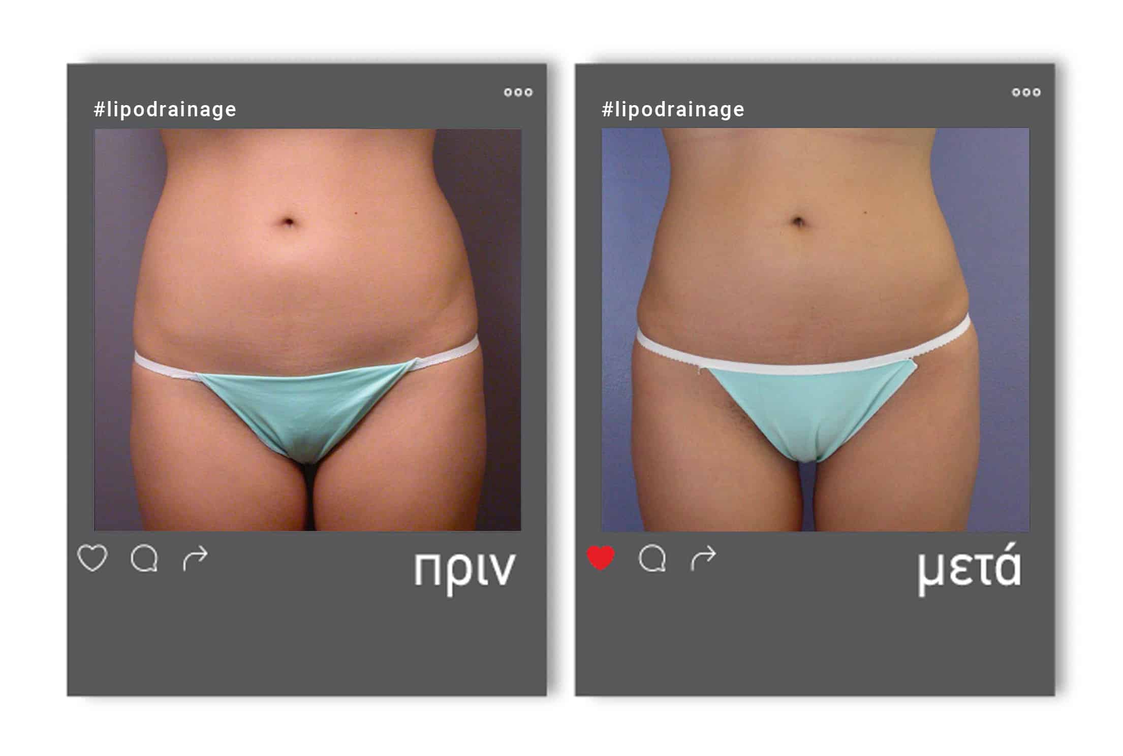 lipodrainage_befafter_3