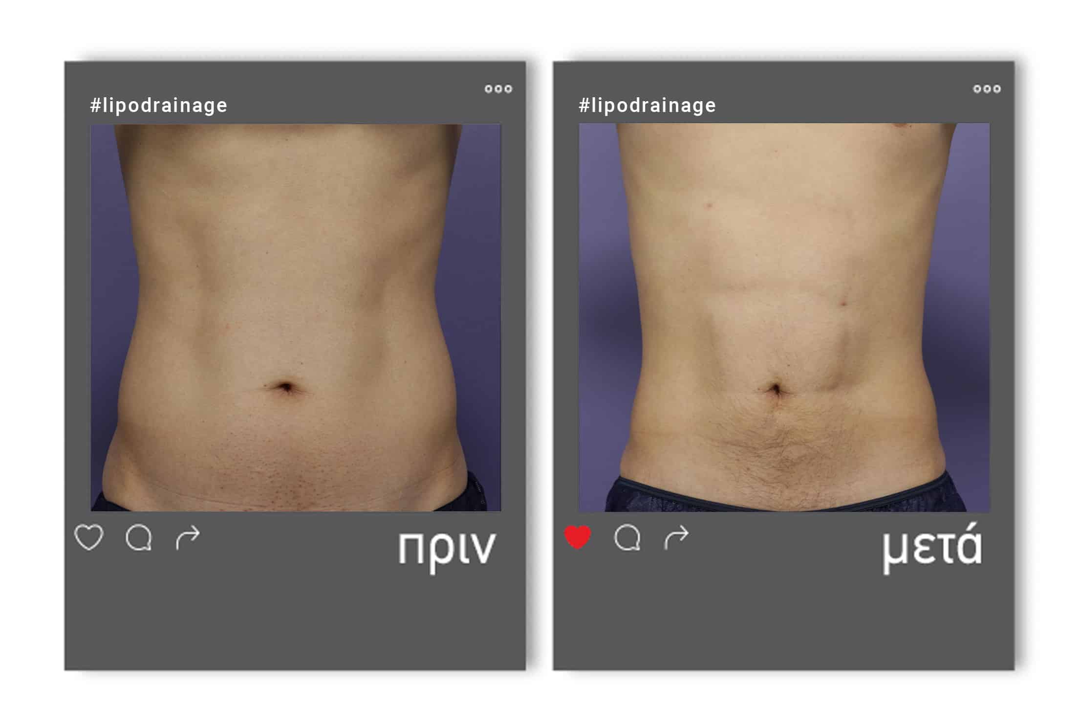 lipodrainage_m_befafter_1