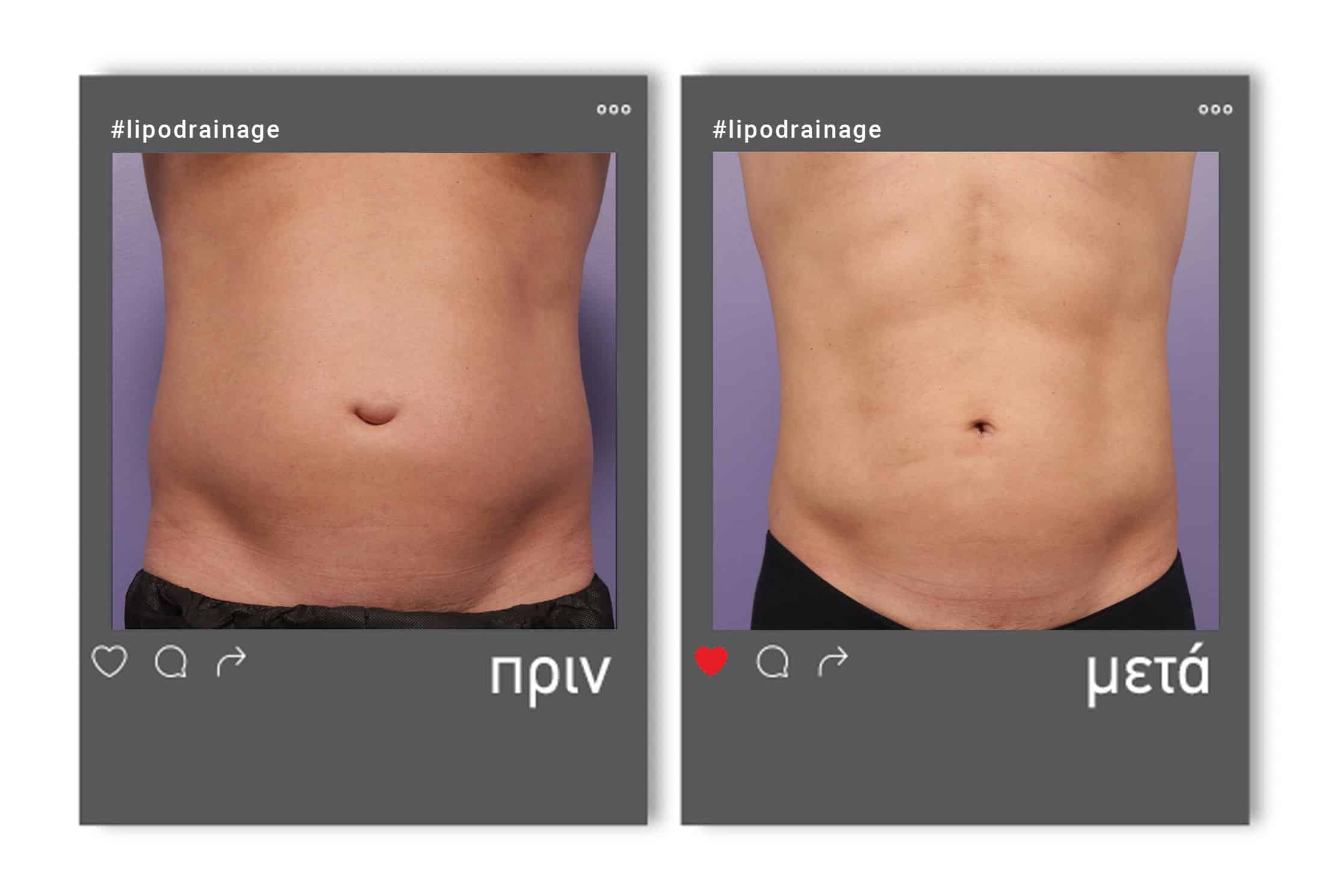 lipodrainage_m_befafter_3